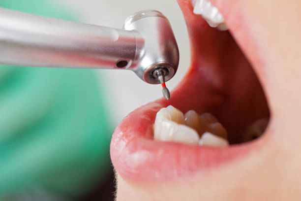 Best Broken or Cracked Tooth Emergency Dentist in Westchase, FL